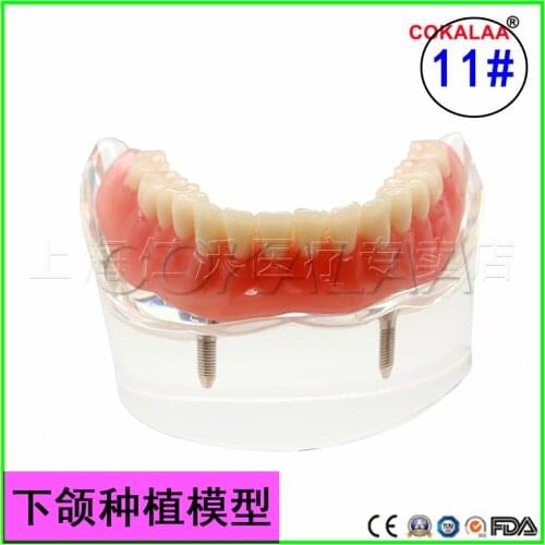 Good quality Mandibular model dental patient communication dental implant model dentures teeth model for dentists learning