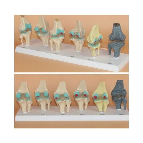 Knee Joint Pathological changes model Disease process Knee lesion model 6pcs set free shipping