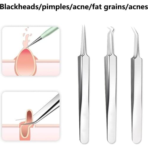 3pcs/set Blackhead Comedone Acne Pimple Blackhead Remover Tool Spoon for Face Skin Care Tool Needles Facial Pore Cleaner