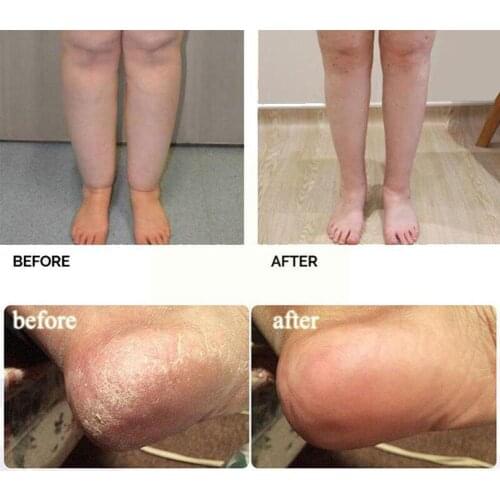 New Fungal Nail Treatment Detox Foot Soak Long-Term Skin Athletes Beriberi Psoriasis Peeling Cracking Relief Foot I2Y1