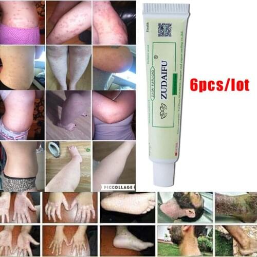6pcs/lot ZUDAIFU men women skin care product relieve Psoriasis Dermatitis Eczema Pruritus effect Without Retail Box Hot Selling