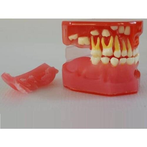 Dental 3 years old Clear Mixed Dentition model