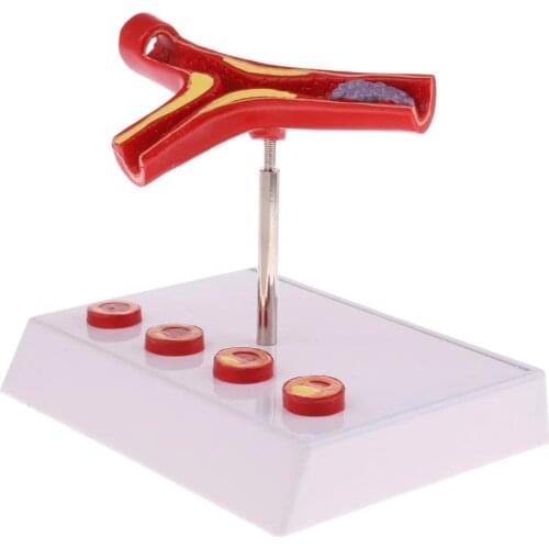 50 Times Enlarged Human Vessel Atherosclerosis Vascular Model Lab Supplies