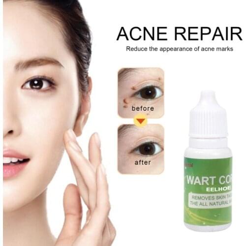 1Pcs Skin Tag Remover Against Mole & Genital Wart fast Removal Mole Removal Dark Spot Remover For Skin Care