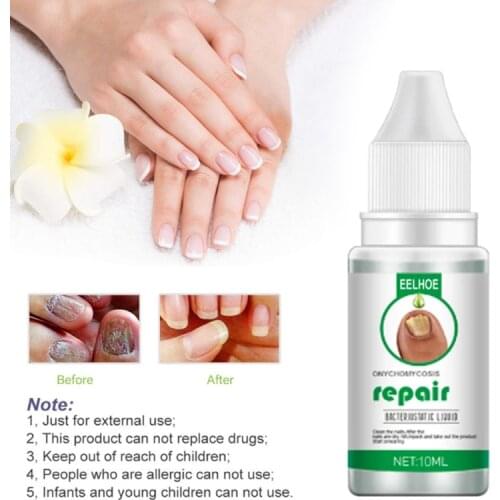 30ml Onychomycosis Repair Liquid Anti-fungal Paronychia Toe Repair Product Thicken Nail Foot Care Beauty & Health TSLM1