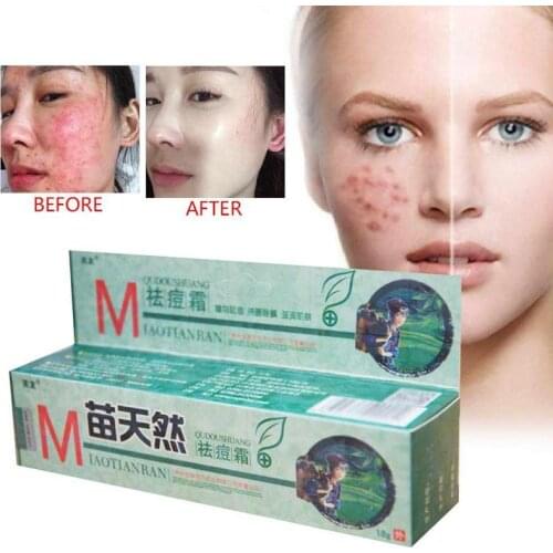 Natural Germicidal Removal Cream Mite Moisturize Skin Cream Original Remove Acne Cream Ointment Soothes Skin Care Hot Sale