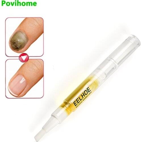 2pcs Anti Fungal Nail Infection Treatment Pen Onychomycosis Paronychia Foot Fungus Nail Cuticle Remover Liquid Nail Skin Care