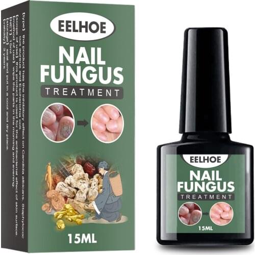 Nail Fungal Cure Nail Fungus Removal Liquid Nutritious Anti Paronychia Onychomycosis Foot Repair Fungal Nail Repair