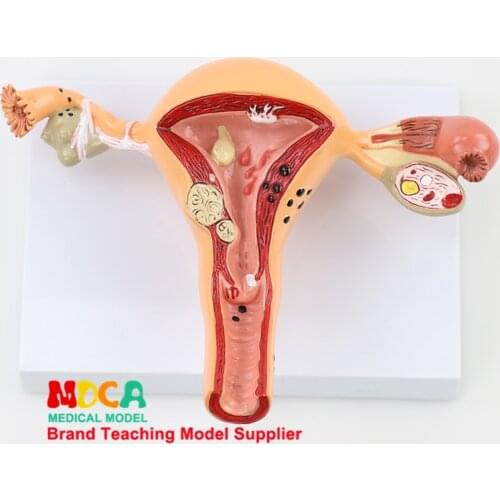 Medical Teaching of Pathological Uterine Reproductive Model for Family Planning Uterine Reproductive Anatomy Model MSZXT001