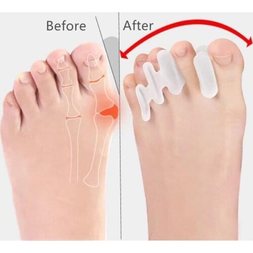 30pieces=15pairs Orthopedic Goods Silicone Hallux Valgus Toe Protector Separators Bunion Corrector Straighten Feet Care Tools