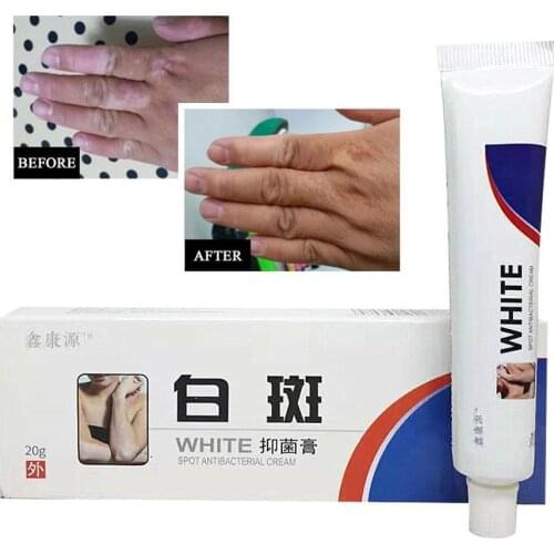 Chinese Medical White Spot Disease Cream Pigment Melanin Disease Skin Treatment Vitiligo Leukoplakia 20g Promoting Liniment T6W5