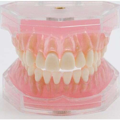 Dental Teeth Model Study Teaching Standard Model Removable Soft Gum Teeth Typodont Dentures Model Dental