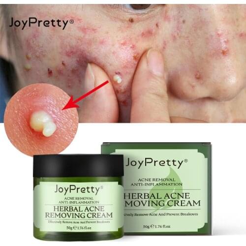 JoyPretty Herbal Acne Removal Cream Anti Inflammation Pimple Acne Treatment Soothe Repair Remove Acne Marks Whitening Skin Care