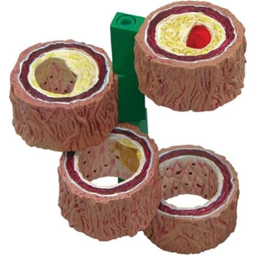 Human Atherosclerosis Thrombosis Model Vascular Disease Demonstration Heart Vascular Pathology Model Medical Teaching Supplies