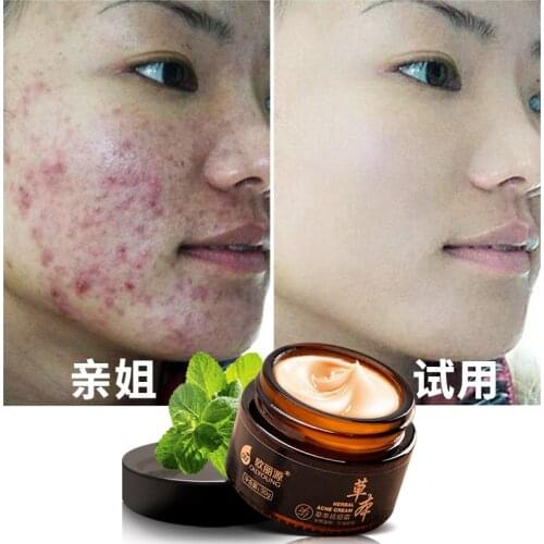 Beauty Skin Face Care Creams Herbal Acne Cream Improve Face Acne Anti Pimple Spot Acne Scars Blackhead Removal Cream Whitening