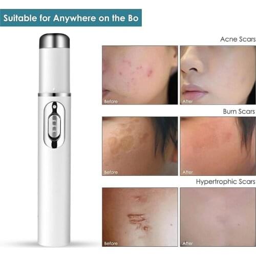 Portable Acne Laser Pen Wrinkle Removal Machine Durable Blue Light Therapy Massage Relax Soft Scar Dark Circles Remover Device