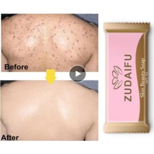 Sulfur Soap Anti Fungus Anti-acne Body Skin Cleansing Soap Skin Cleaning Acne Seborrhea Anti Fungus Bath Soap Anti-mite Soap