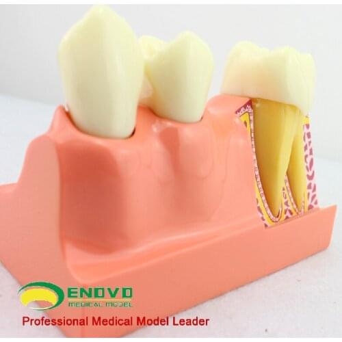 Tooth disintegration model dental anatomy model stomatology teaching