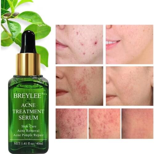 Camellia Sinensis Leaf Extract Treat Acne Remove Pimples Face Serum Moisturizng Skin Repair Acne Skin Green Tea Facial Essence