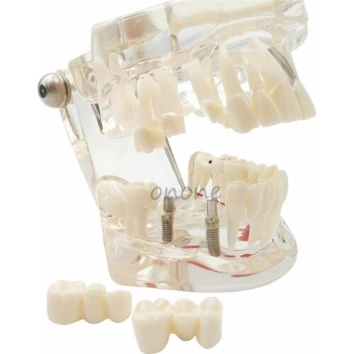 1 Pcs Dental Model Teeth Implant Restoration Bridge Teaching Study Tooth Medical Science Disease Dentist Dentistry Products