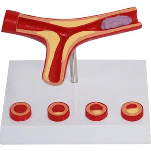Atherosclerosis Model Structure Human Vessel Medical Anatomical Model for School Teaching Tool Learning Display