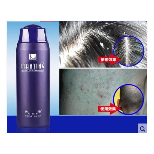 Hot!!! ManTing Professional Shampoo divide mite suppression mite itching Suitable for all hair types Anti-Dandruff Anti-Itching