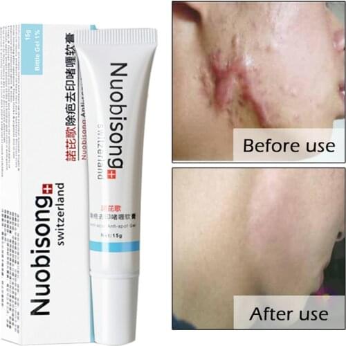 Nuobisong face care acne scar removal cream Acne Spots skin care treatment whitening face cream stretch marks moisturizing