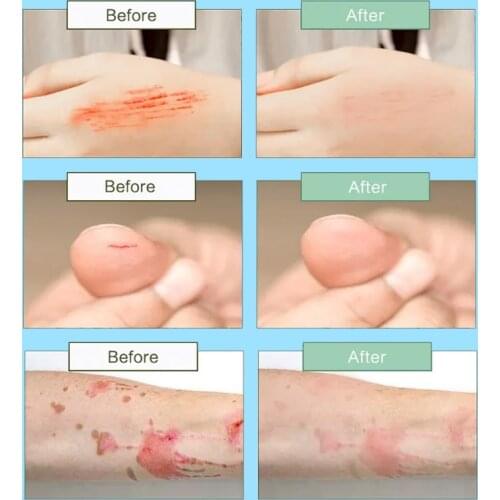 Removes Maternal Skin Repair Body Cream release Postpartum Scar Care Gentle Moisturizing Smooth skin