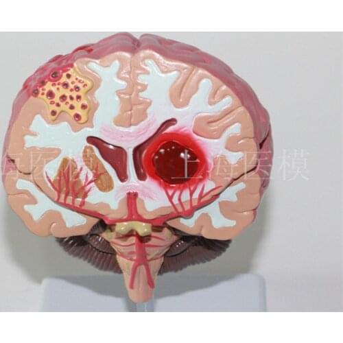 Brain Stroke model cerebral palsy brain tumor brain disease model stroke model neurology brain model