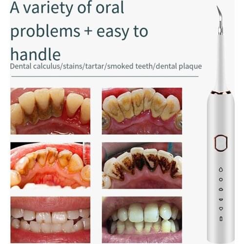 Ultrasonic Scaler To Remove Tartar, Portable Electric Scaler, Smoke Stains, Tartar, Plaque Remover, Tartar Cleaning Tool