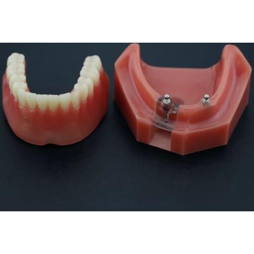 Dental Implant Model Inferior Overdenture 2 Implants Restoration Teeth Demo 6007