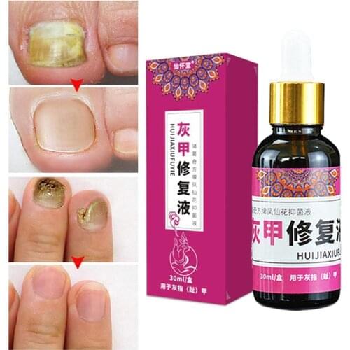20ml Foot Repair Essence Care Anti-Fungal Nail Fungal Nail Treatment Serum Onychomycosis Paronychia Infection Herbal Toe Fungus