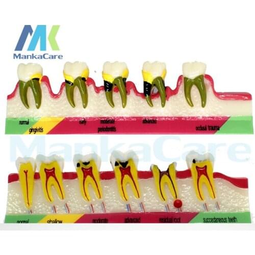 Dental Model Periodontal Disease Assort Tooth Typodont Teach Model 2 type dental teeth model