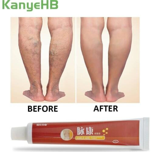 2pcs Varicose Veins Treatment Ointment Varicosity Angiitis Removal Vasculitis Phlebitis Spider Leg Pain Relieving Herbal Plaster