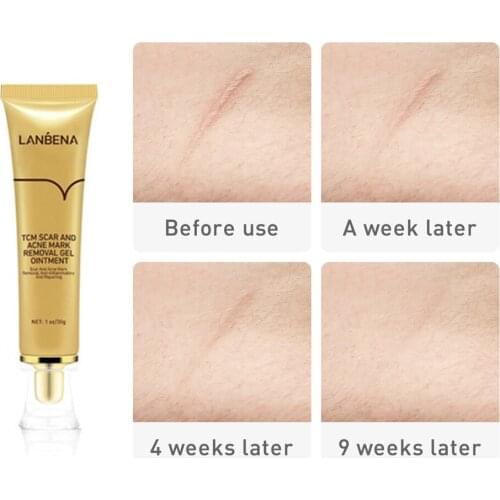 LANBENA Acne Scar Removal Cream Skin Repair Face Cream Acne Spots Acne Treatment Blackhead Anti Scar Marks Repair Skin Care