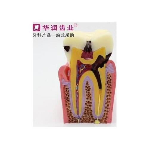 Dentistry Dental model 6XCaries oral cavity model free shipping