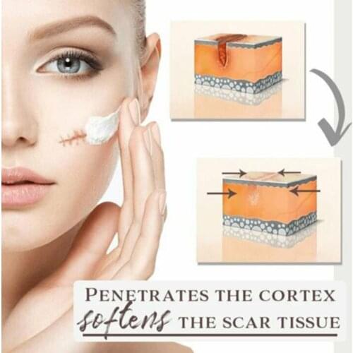 Youthful Scar Remover Cream Scars Removing Gel for Face Body Stretch Marks 30ml SSwell