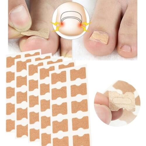 1/5/10/20PCS Ingrown Toenail Correction Stickers Glue Free Ingrown Patch Finger Incorporated Orthodontic Toe Thumb Patch Sticker