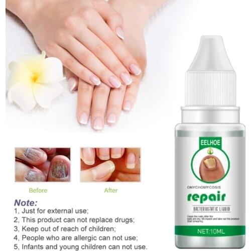 10/20/30ML Fungal Nail Repair Serum Foot Care Onychomycosis Treatment Nail Fungus Anti Infection Paronychia Nail Treatment