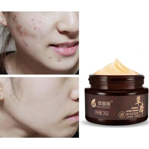 Herbal Acne Cream Anti Pimple Spot Acne Scars Blackhead Removal Cream Whitening Beauty Skin Face Care Creams Acne Treament