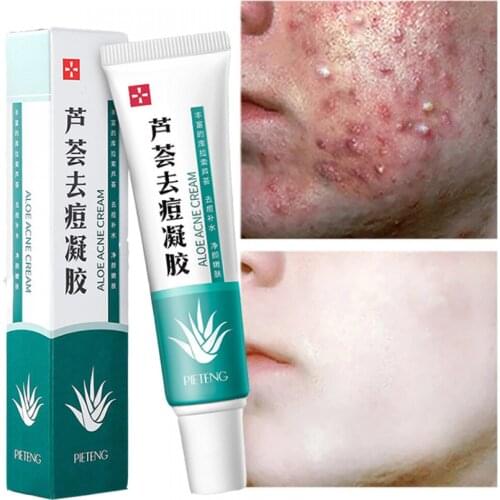 Acne Aloe Vera Gel Face Cream Skin Care Remove Acne Moisturizing Day Cream Repair After Sunburn Sooth Aloe Gel