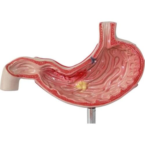 Human Stomach Model Gastric Ulcer Anatomy Model Medical Science Teaching Resources Dropshipping