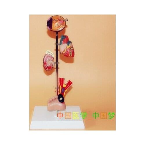 Diabetes pathology model heart kidney eye model Medical Teaching free shipping