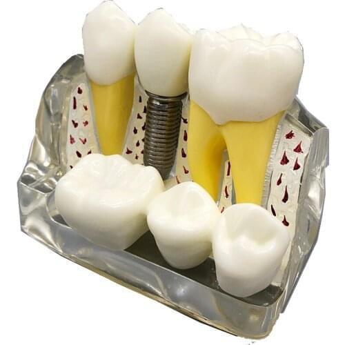 Dental Clear 4 Times Implantation Interpretation Model Removable Implant Nail Bridging Crown Implant Teeh Model M2017T