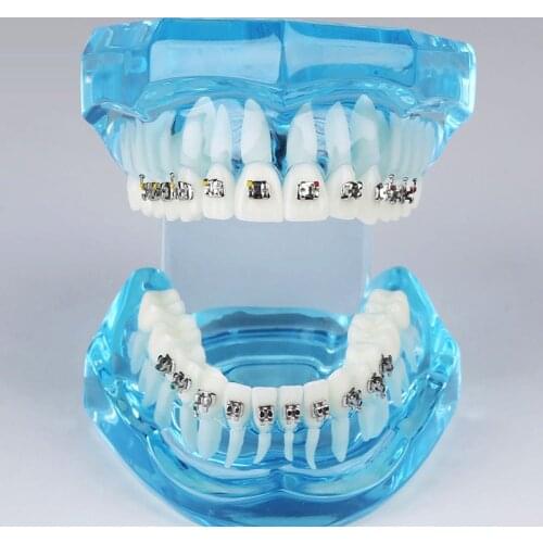 Sales M3001 Orthodontic Tooth Model with Metal Brackets