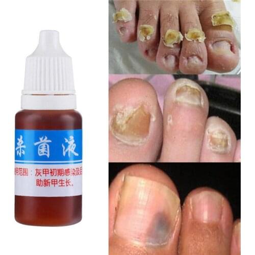 10ml Health Skin Care Nail Repair Liquid Cleanser Onychomycosis Remover Nail Essence Infection Finger Repair Antifungal