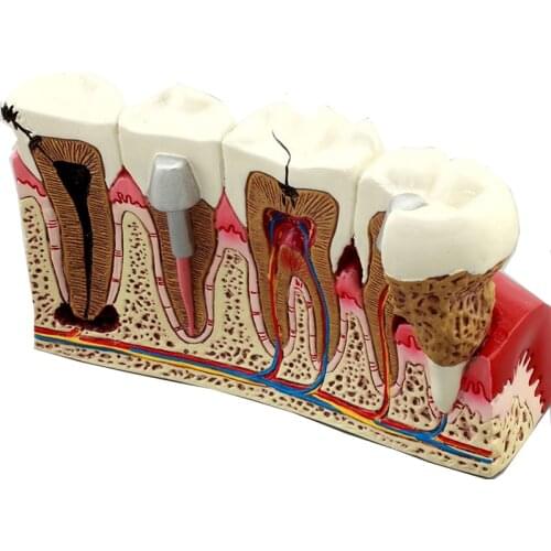Dental teeth pathologies model M4029 Dental Teaching model Dentist for Dental Communication Model/Dental Caries Teeth Model