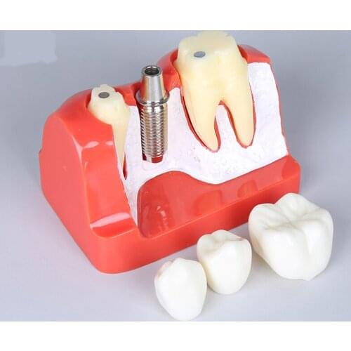 Dental Implant Analysis teeth model M2017R Dental Implant Teeth Model With Fixtures and Bridge Dental Study Teeth Model