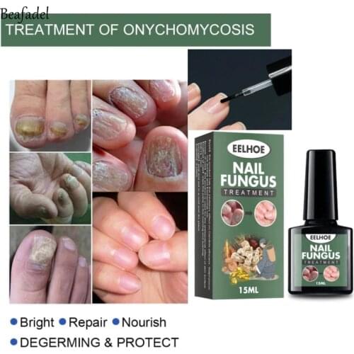 Nail Repair Liquid Fungal Liquid Hand And Foot Anti Paronychia Onychomycosis Nail Antifungal Anti Fungus Toe Nail Care Efficient