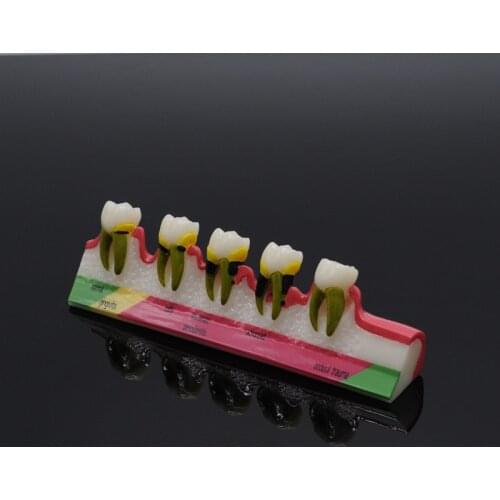 Periodontal Disease Assort Tooth Typodont Model Study Teaching Model For Dentistry Lab Equipment